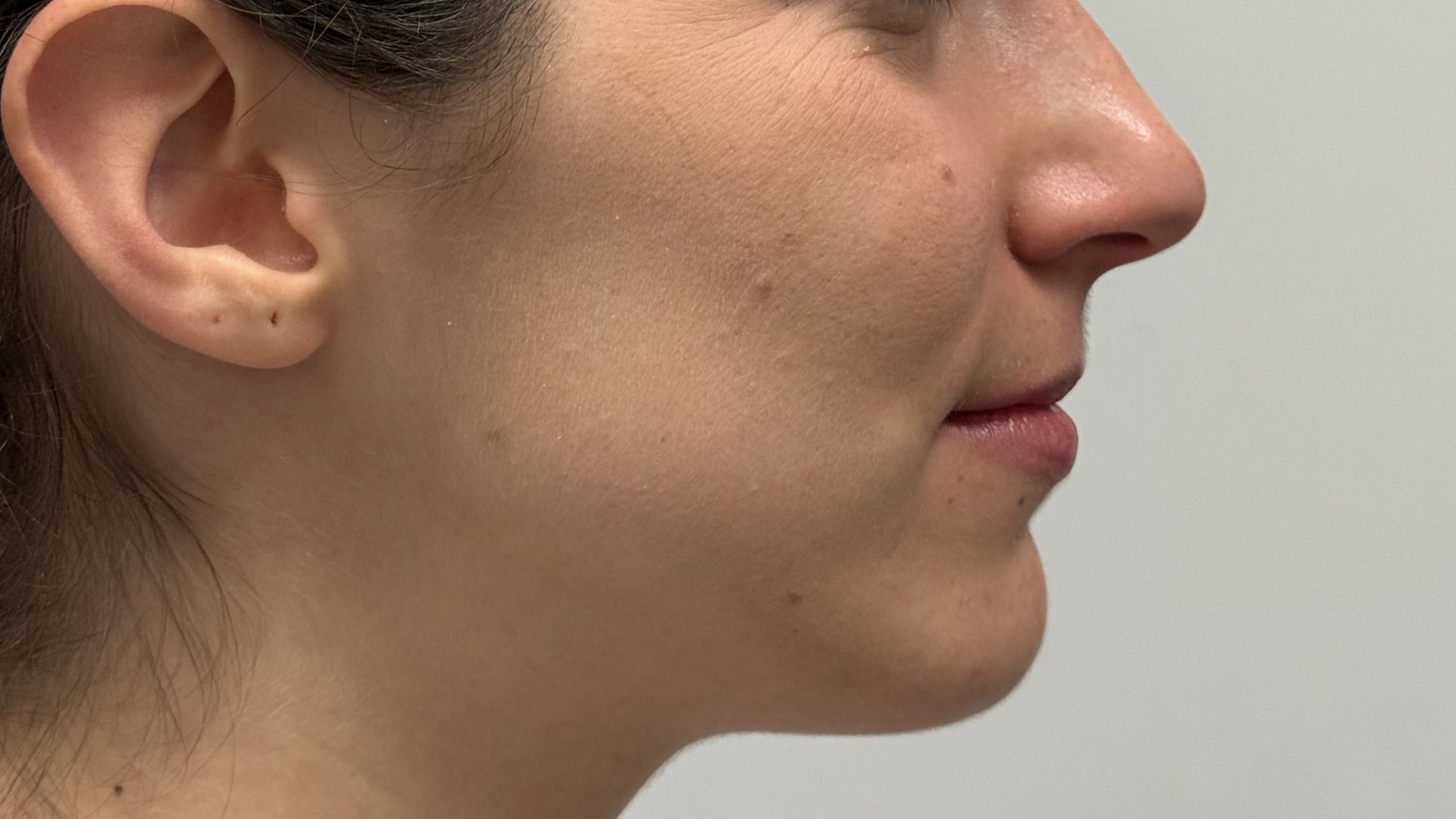 Gesicht nachher von der Seite