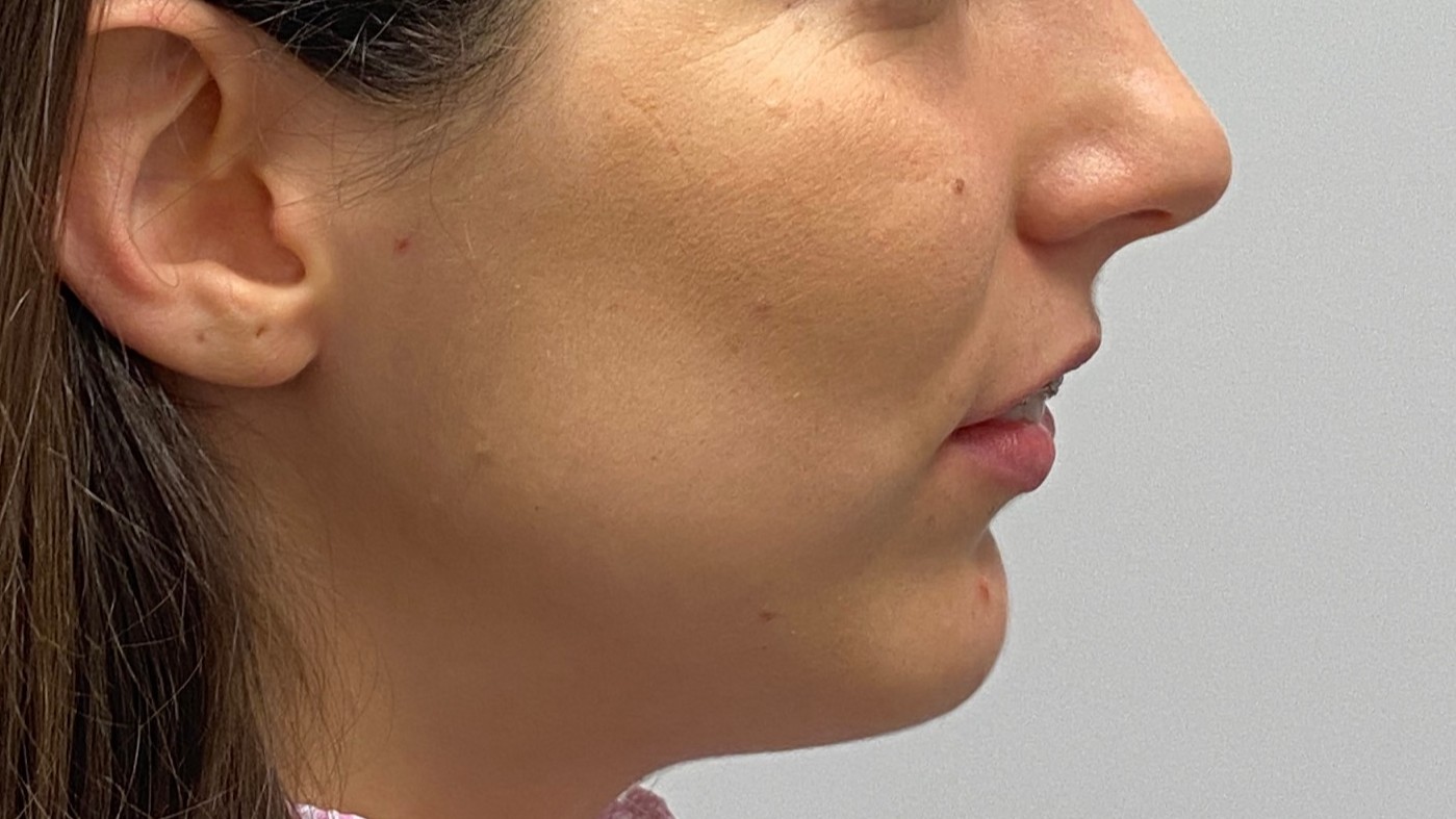 Gesicht vorher von der Seite